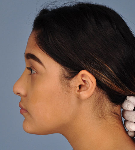 girl after rhinoplasty after nasal trauma
