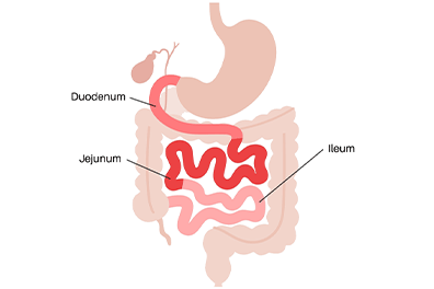 Intestinal atresia - jejunal and ileal - Children's Health