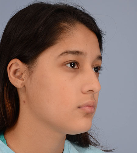 girl before rhinoplasty after nasal trauma