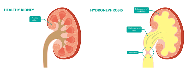 Pediatric hydronephrosis - Children's Health