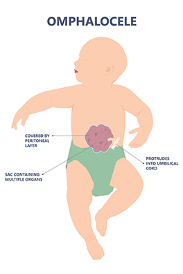 Omphalocele - Children's Health