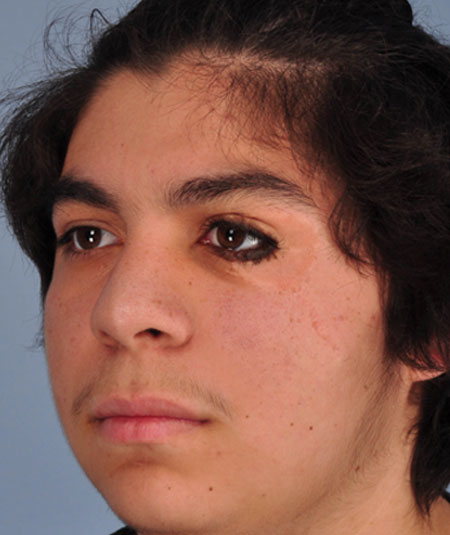 After nevus removal by plastic surgery