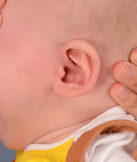 infant's ear after ear molding and reconstruction