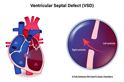 Ventricular septal defect (VSD) - Children's Health