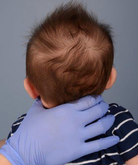 baby with metopic craniosynostosis before strip craniectomy