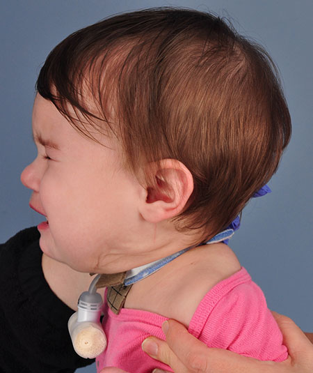 after venolymphatic malformation removal from infant
