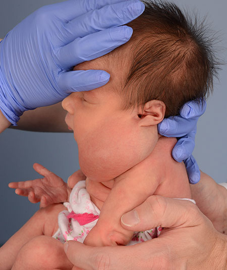 before venolymphatic malformation removal from infant
