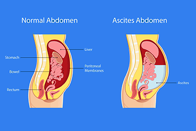 Pediatric ascites - Children's Health