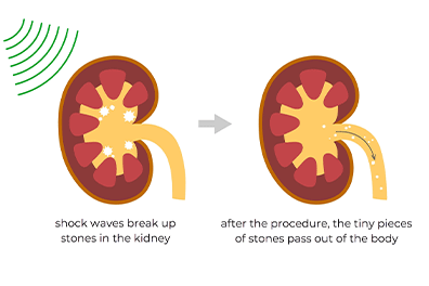 Pediatric extracorporeal shock wave lithotripsy (ESWL) - Children's Health