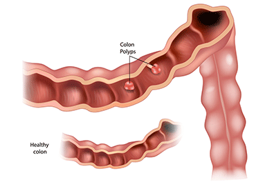 Colon polyps - Children's Health