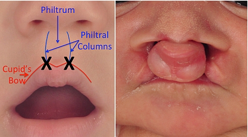 diagram of a child's nose and cupid's bow