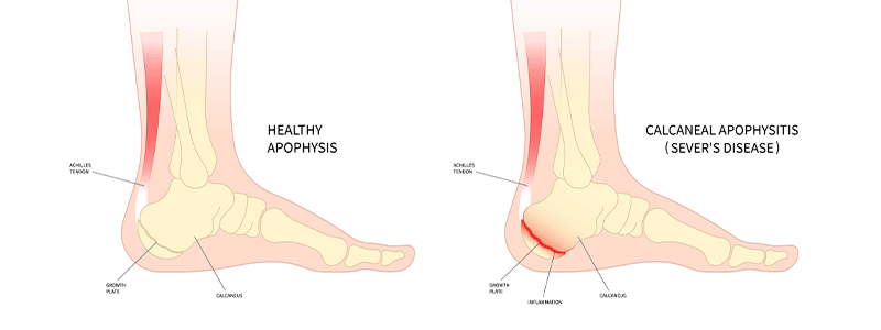 Calcaneal Apophysitis (Sever's Disease) - Children's Health