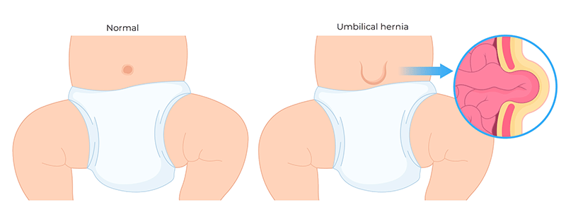 Pediatric Umbilical Hernia - Children's Health