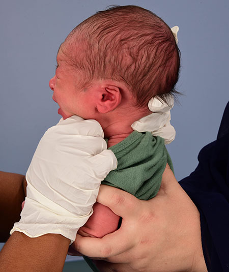 baby born with Cryptotia of his left ear and had non-surgical ear molding treatment