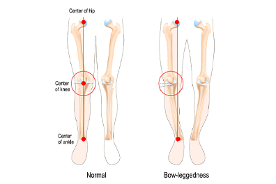 Bowed Legs illistration - Children's Health