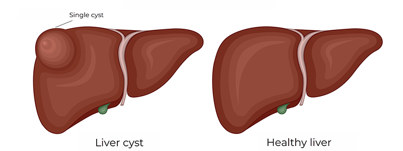 Pediatric Liver Cyst - Children's Health