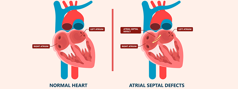 Atrial Spetal defect (ASD) - Children's Health