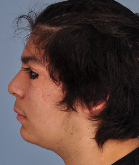 After nevus removal by plastic surgery