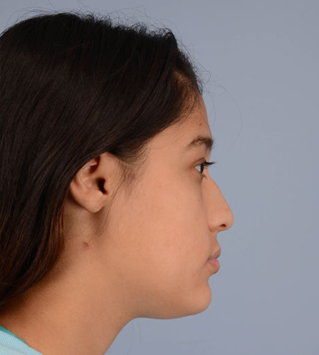 girl before rhinoplasty after nasal trauma