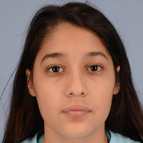 girl before rhinoplasty after nasal trauma