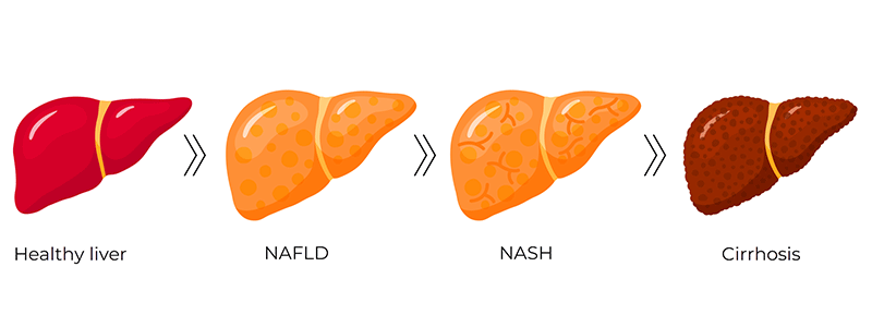 NAFLD and NASh Liver Disease - Children's Health