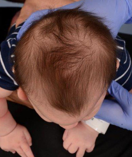 baby with metopic craniosynostosis before strip craniectomy