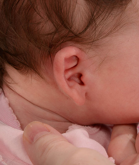 baby with constricted ear before ear molding treatment