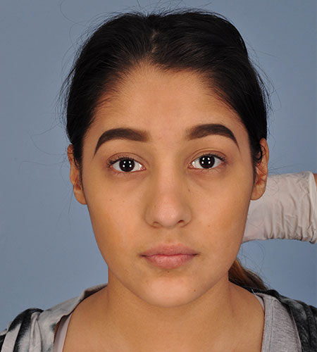 girl before rhinoplasty after nasal trauma
