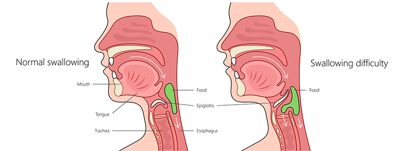 Dysphagia or swallowing problems - Children's Health