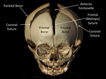 pediatric craniosynostosis