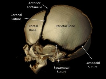 pediatric craniosynostosis