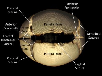 pediatric craniosynostosis