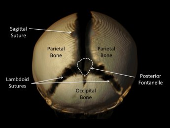 pediatric craniosynostosis