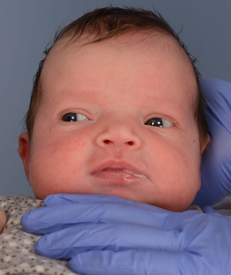 before photo of baby girl with sagittal strip craniosynostosis treated at Children's Health