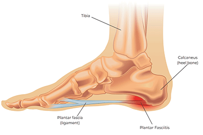 Plantar fasciitis in children - Children's Health