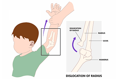 Nursemaid's Elbow - Children's Health