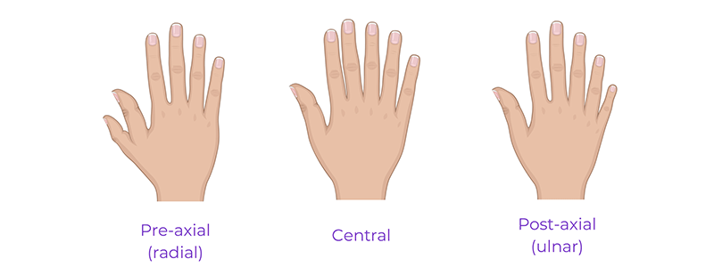 Pediatric polydactyly - Children's Health