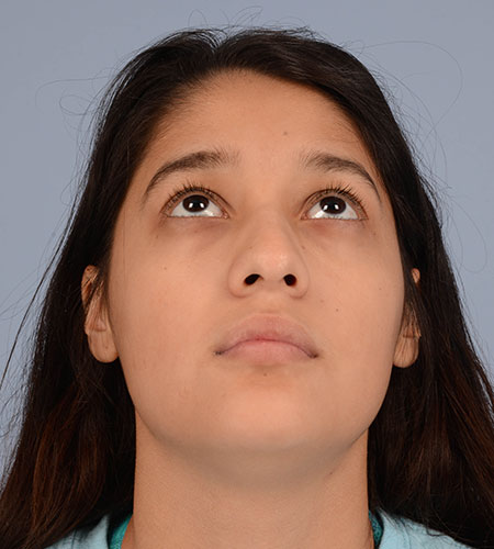 girl before rhinoplasty after nasal trauma