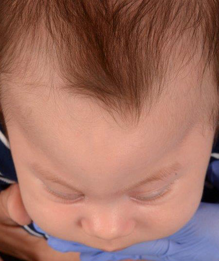 baby with metopic craniosynostosis before strip craniectomy