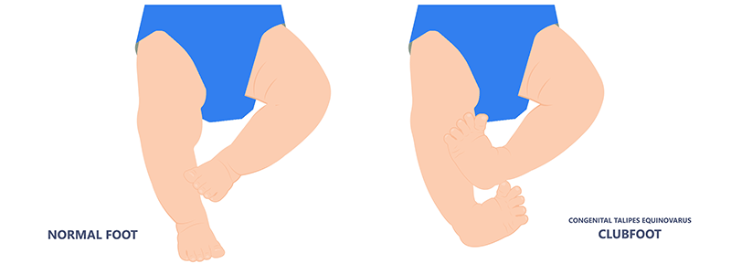 Clubfoot - Children's Health