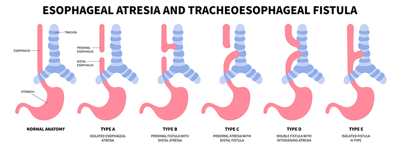 Pracheoesophageal fistula in children - Children's Health