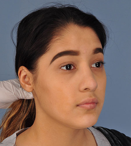 girl after rhinoplasty after nasal trauma