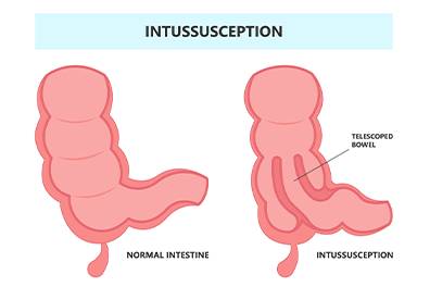 Pediatric intussusception - Children's Health