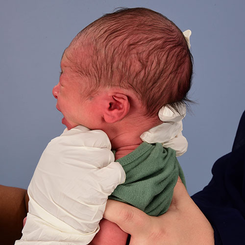 baby born with Cryptotia of his left ear and had non-surgical ear molding treatment