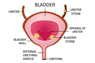 Bladder stones in Kids - Children's Health