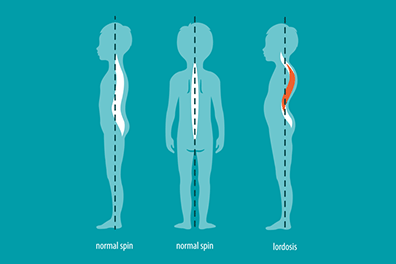 Pediatric lordosis (sway back) - Children's Health