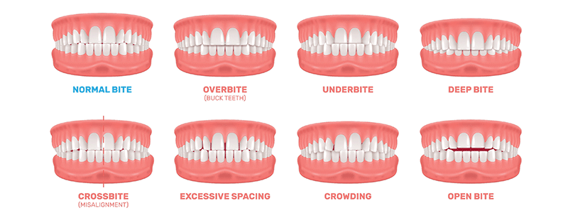 Jaw Disorders - Children's Health