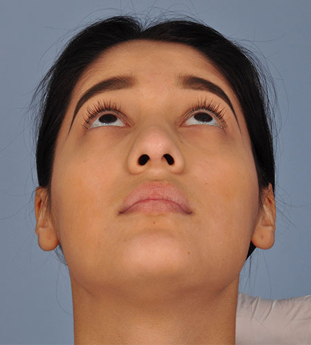 girl after rhinoplasty after nasal trauma
