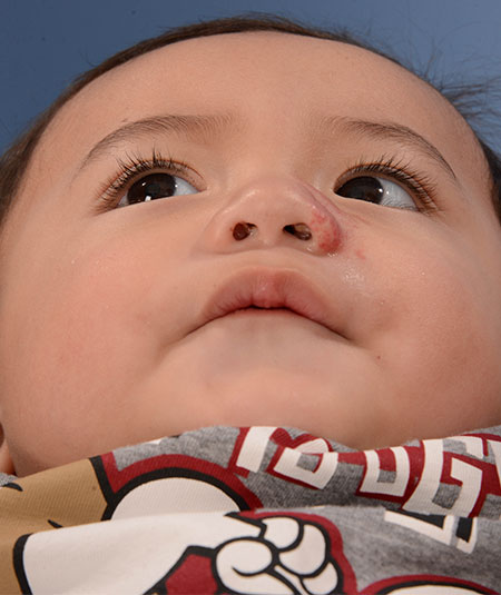 after photo of boy with nasal hemangioma removed